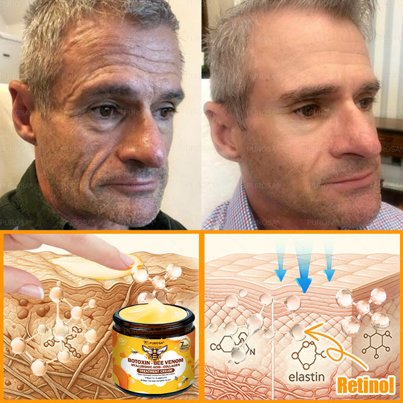 🔥 🗽🔥Made & Shipped from USA | Clinically Proven: PUROSA® Bee Venom Treatment Cream with bee venom peptides, botulinum toxin, hyaluronic acid, and collagen💧. Targets wrinkles, fine lines, sagging, stretch marks, dark spots—firming, lifting and more
