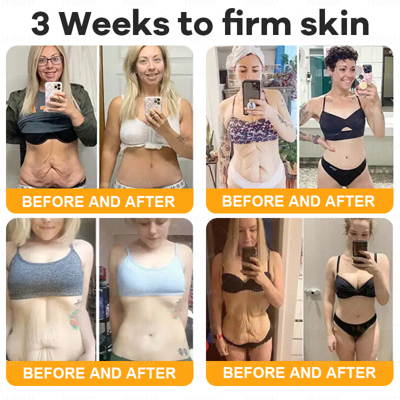 🔥 🗽🔥Made & Shipped from USA | Clinically Proven: PUROSA® Bee Venom Treatment Cream with bee venom peptides, botulinum toxin, hyaluronic acid, and collagen💧. Targets wrinkles, fine lines, sagging, stretch marks, dark spots—firming, lifting and more