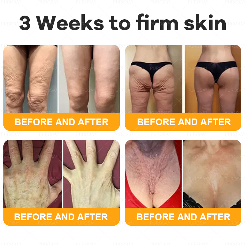 🔥 🗽🔥Made & Shipped from USA | Clinically Proven: PUROSA® Bee Venom Treatment Cream with bee venom peptides, botulinum toxin, hyaluronic acid, and collagen💧. Targets wrinkles, fine lines, sagging, stretch marks, dark spots—firming, lifting and more