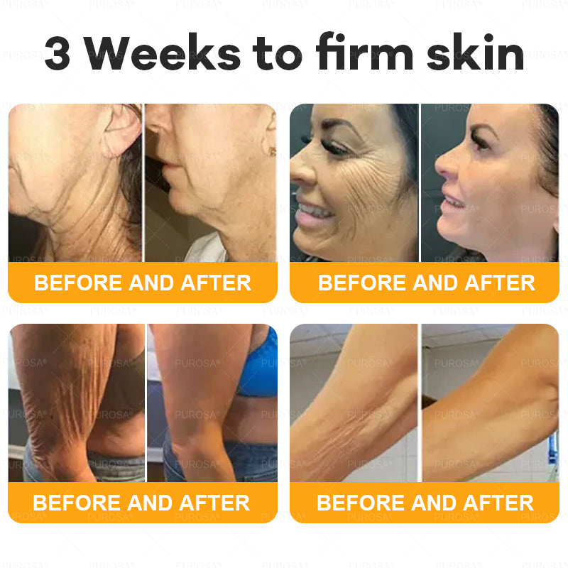 🔥 🗽🔥Made & Shipped from USA | Clinically Proven: PUROSA® Bee Venom Treatment Cream with bee venom peptides, botulinum toxin, hyaluronic acid, and collagen💧. Targets wrinkles, fine lines, sagging, stretch marks, dark spots—firming, lifting and more
