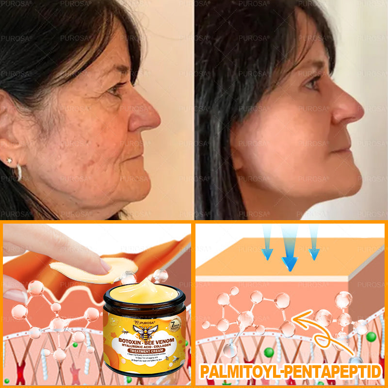 🔥 🗽🔥Made & Shipped from USA | Clinically Proven: PUROSA® Bee Venom Treatment Cream with bee venom peptides, botulinum toxin, hyaluronic acid, and collagen💧. Targets wrinkles, fine lines, sagging, stretch marks, dark spots—firming, lifting and more